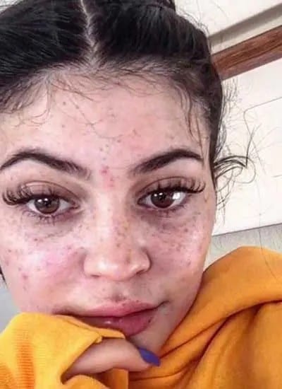 Kylie Jenner's Face Covered With Acne Bumps In Viral Pic