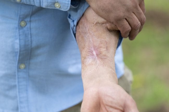 Man Who Lost Penis To Blood Infection Has Replacement Built On His Arm