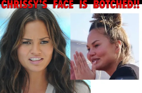 New Pics Of Chrissy Teigen's Face Suggests It's Botched 