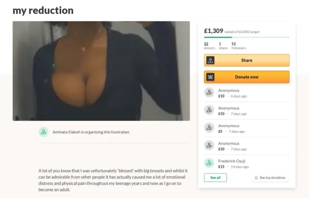 College Student Creates GoFundMe To Get Breast Reduction