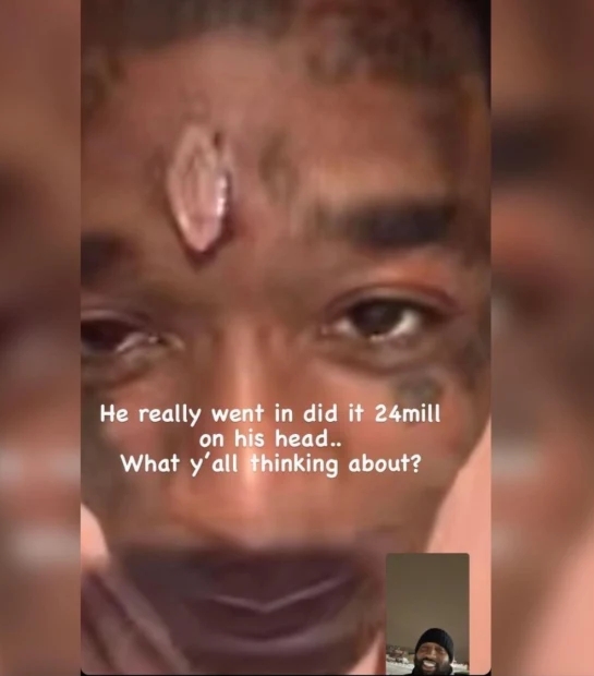 Lil Uzi Vert Shows Off Newly Implanted $24 Million Pink Diamond On Forehead