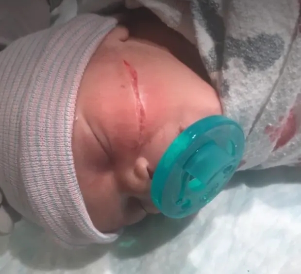 Baby's Face Slashed By Doctors During C-Section