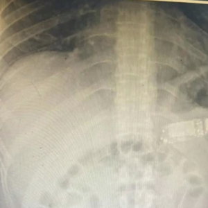 Kosovo Man Accidentally Swallows Nokia 3310 Phone And Has It Removed From His Stomach
