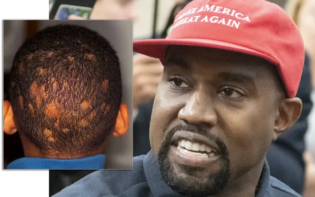 Kanye West Has Been Wearing Face Masks Because He Has Ringworm - Report