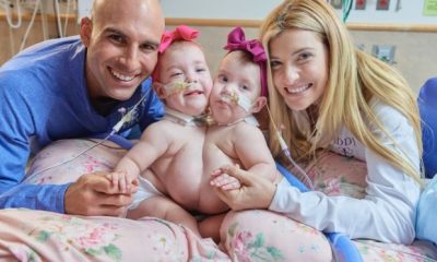 Conjoined Twin Girls Joined At The Chest Successfully Separated
