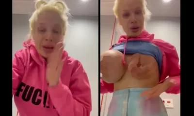 Instagram Model Goes Viral After Br**st Implants Exploded 