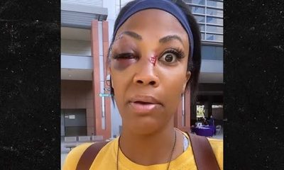 Kim Glass Shows Her Injuries After Being Attacked By Homeless Man