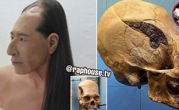 2,000 Year Old Skull Held Together By Metal Offers Proof Of Ancient Advanced Surgery
