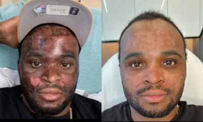 TikTok Star Neyo White Awarded $1M In Damages For Severe Burns From Chemical Peel At Skincare Bar In Atlanta