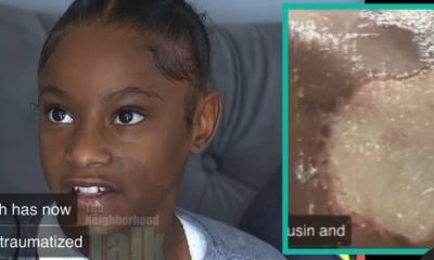 11-Year-Old Girl Suffers Chemical Burns After A Child's Mother Gave Them Acid To Throw On Her