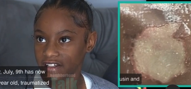 11-Year-Old Girl Suffers Chemical Burns After A Child's Mother Gave Them Acid To Throw On Her